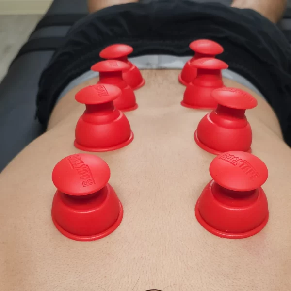 Cupping