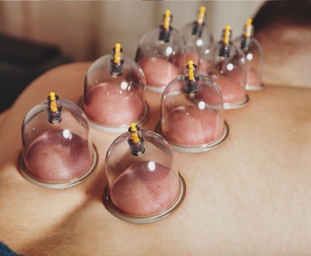 Does Cupping Pull Out Knots and Release Muscle Tension