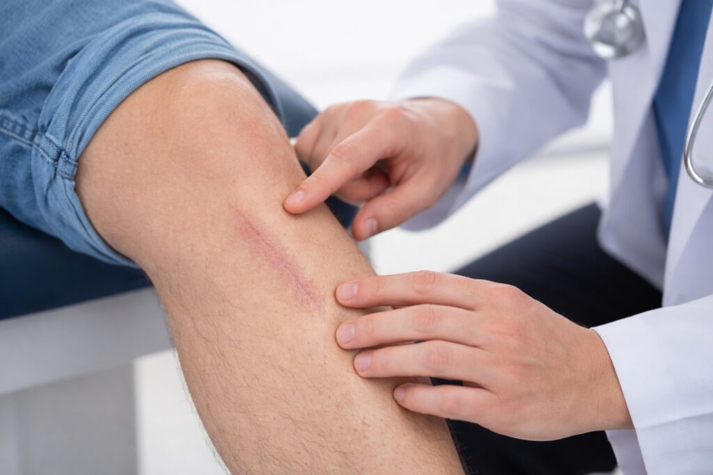 Types of Scar Tissue and How They Affect Movement