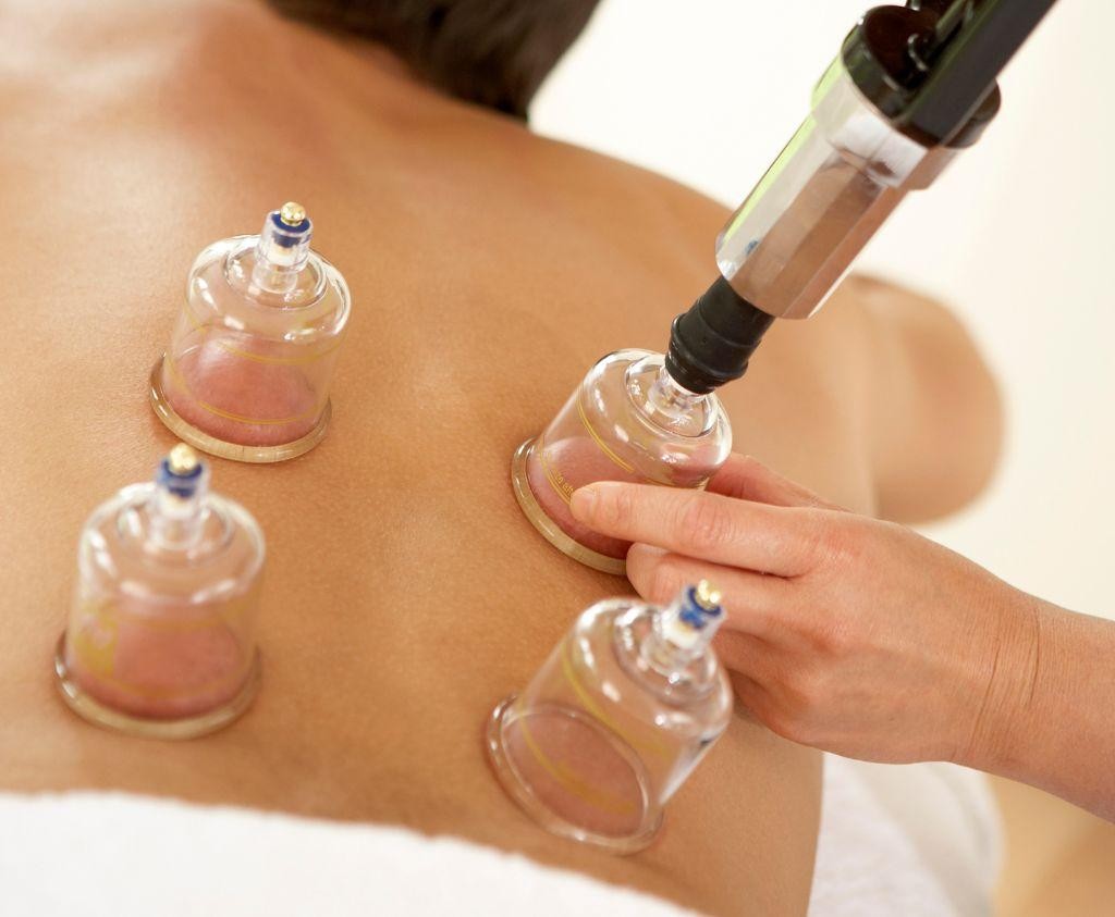 What Is Cupping Therapy and How It Works